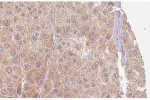 ABIN6277408 at 1/100 staining Human Melanoma tissue by IHC-P. (MMP11 antibody  (N-Term))