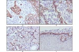 Immunohistochemical analysis of paraffin-embedded human lung cancer (A), endometrial carcinoma (B), sublingual gland (C) and esophagus (D) tissues using CK17 mouse mAb with DAB staining. (KRT17 antibody)