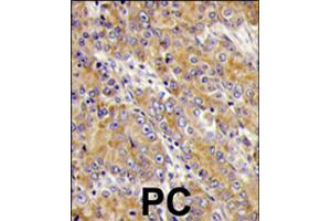 Formalin-fixed and paraffin-embedded human prostate carcinoma tissue reacted with MYO1C polyclonal antibody  , which was peroxidase-conjugated to the secondary antibody, followed by DAB staining .