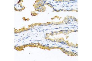 Immunohistochemistry of paraffin-embedded human prostate cancer using CPB2 antibody at dilution of 1:100 (40x lens). (CPB2 antibody)