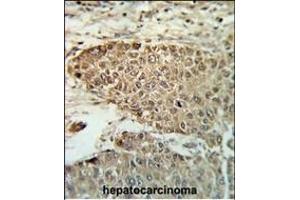 Formalin-fixed and paraffin-embedded human hepatocarcinoma reacted with BIN3 Antibody (N-term), which was peroxidase-conjugated to the secondary antibody, followed by DAB staining. (BIN3 antibody  (N-Term))