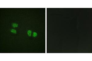 P-peptide - +Immunohistochemistry analysis of paraffin-embedded human breast carcinoma tissue using DDX5/DEAD-box Protein 5 (Phospho-Tyr593) antibody. (DDX5 antibody  (pTyr593))