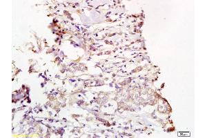 Formalin-fixed and paraffin embedded human breast carcinoma labeled with Rabbit Anti Phospho-MEK1/2(Ser218/222) Polyclonal Antibody, Unconjugated (ABIN743813) at 1:200 followed by conjugation to the secondary antibody and DAB staining (MEK1/2 antibody  (pSer218, pSer222))