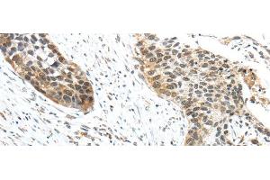 Immunohistochemistry of paraffin-embedded Human esophagus cancer tissue using TRIP6 Polyclonal Antibody at dilution 1:50 (TRIP6 antibody)