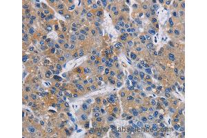Immunohistochemistry of Human liver cancer using GPM6A Polyclonal Antibody at dilution of 1:40 (GPM6A antibody)