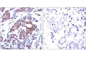 Immunohistochemistry analysis of paraffin-embedded human breast carcinoma, using Elk1 (Phospho-Ser383) Antibody. (ELK1 antibody  (AA 351-400))