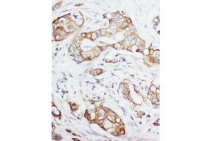 Anti-IGF1 antibody, IHC(P) IHC(P): Human Mammary Cancer Tissue (IGF1 antibody  (Middle Region))