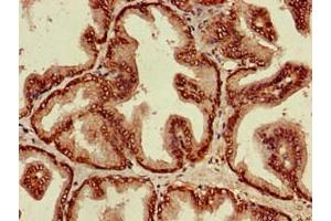 Immunohistochemistry of paraffin-embedded human prostate cancer using ABIN7143803 at dilution of 1:100