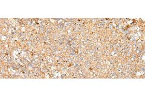 Immunohistochemistry of paraffin-embedded Human cervical cancer tissue using PRDX4 Polyclonal Antibody at dilution of 1:25(x200) (Peroxiredoxin 4 antibody)