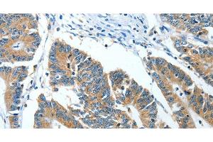 Immunohistochemistry of paraffin-embedded Human colon cancer tissue using ANGPT1 Polyclonal Antibody at dilution 1:50 (Angiopoietin 1 antibody)