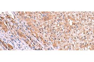 Immunohistochemistry of paraffin-embedded Human liver cancer tissue using TTC38 Polyclonal Antibody at dilution of 1:85(x200) (TTC38 antibody)
