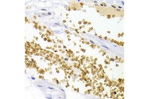 Immunohistochemistry of paraffin-embedded human stomach cancer using OPRL1 antibody at dilution of 1:200 (400x lens). (OPRL1 antibody)
