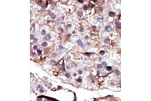 Formalin-fixed and paraffin-embedded human cancer tissue (hepatocarcinoma) reacted with the primary antibody, which was peroxidase-conjugated to the secondary antibody, followed by AEC staining. (SPHK2 antibody  (N-Term))