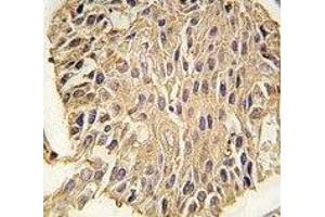 IHC analysis of FFPE human lung carcinoma tissue stained with ALDOA antibody (ALDOA antibody  (AA 303-331))