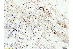 Formalin-fixed and paraffin embedded human colon tissue labeled with Anti Prominin2 Polyclonal Antibody, Unconjugated (ABIN715151) at 1:200 followed by conjugation to the secondary antibody and DAB staining (Prominin 2 antibody  (AA 301-400))