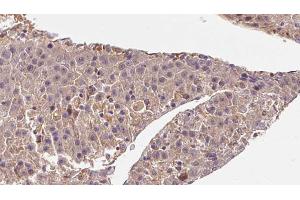ABIN6272844 at 1/100 staining Human liver cancer tissue by IHC-P. (ARL13B antibody)