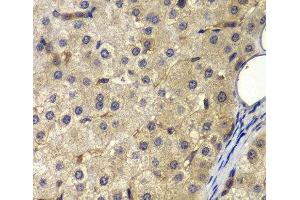 Immunohistochemistry of paraffin-embedded Human liver cancer using AP2A2 Polyclonal Antibody at dilution of 1:200 (40x lens). (AP2A2 antibody)