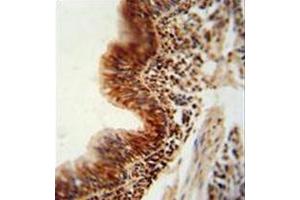 Formalin fixed, paraffin embedded human lung carcinoma stained with RBM43 antibody (N-term) followed by peroxidase conjugation of the secondary antibody and DAB staining. (RBM43 antibody  (N-Term))