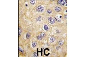 Formalin-fixed and paraffin-embedded human hepatocarcinoma tissue reacted with hCLDN1-Loop1 (ABIN390289 and ABIN2840728) , which was peroxidase-conjugated to the secondary antibody, followed by DAB staining. (Claudin 1 antibody  (AA 40-82))