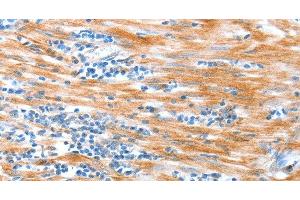 Immunohistochemistry of paraffin-embedded Human esophagus cancer using ALDOB Polyclonal Antibody at dilution of 1:40 (ALDOB antibody)
