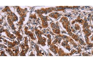 Immunohistochemistry of paraffin-embedded Human breast cancer tissue using ID2 Polyclonal Antibody at dilution 1:30 (Id2 antibody)
