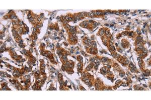 Immunohistochemistry of paraffin-embedded Human breast cancer tissue using ID2 Polyclonal Antibody at dilution 1:30