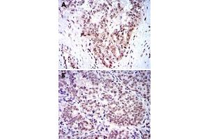 Immunohistochemical analysis of paraffin-embedded human ovarian cancer tissue (A) and cervical cancer tissue (B) using SKP1 monoclonal antobody, clone 1H9  with DAB staining.