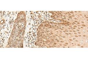 Immunohistochemistry of paraffin-embedded Human esophagus cancer tissue using ARMC8 Polyclonal Antibody at dilution of 1:40(x200) (ARMC8 antibody)