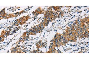 Immunohistochemistry of paraffin-embedded Human gastic cancer using PIP4K2A Polyclonal Antibody at dilution of 1:40 (PIP4K2A antibody)