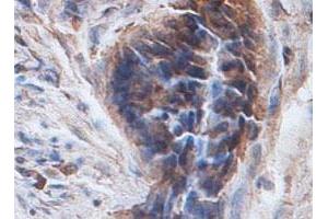 Immunohistochemical staining of formalin-fixed paraffin-embedded human colon carcinoma tissue showing cytoplasmic staining with PTPN12 polyclonal antibody  at 1 : 100 dilution. (PTPN12 antibody  (AA 544-771))