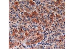 Detection of RXFP1 in Human Liver Cancer Tissue using Polyclonal Antibody to Relaxin/Insulin Like Family Peptide Receptor 1 (RXFP1) (RXFP1 antibody  (AA 260-409))