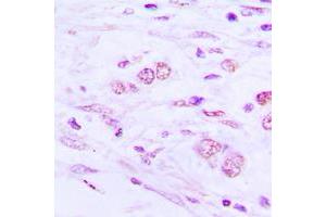 Immunohistochemical analysis of BAIAP2L1 staining in human lung cancer formalin fixed paraffin embedded tissue section. (BAIAP2L1 antibody  (Center))