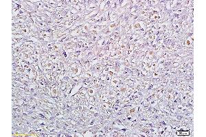 Formalin-fixed and paraffin embedded human cervical carcinoma labeled with Anti Sertad1 Polyclonal Antibody, Unconjugated (ABIN720011) at 1:200 followed by conjugation to the secondary antibody and DAB staining (SERTAD1 antibody  (AA 1-42))