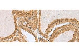 Immunohistochemistry of paraffin-embedded Human thyroid cancer tissue using EXOSC4 Polyclonal Antibody at dilution of 1:50(x200)