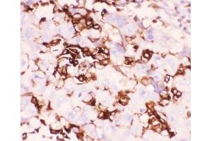 IHC-P: LFA-1 antibody testing of human lung cancer tissue (ITGAL antibody  (AA 404-769))