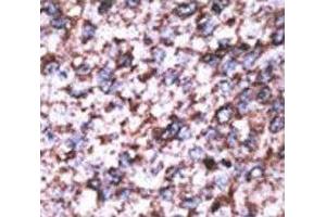 IHC analysis of FFPE human hepatocarcinoma stained with the BACE2C antibody (BACE2C antibody  (AA 310-339))