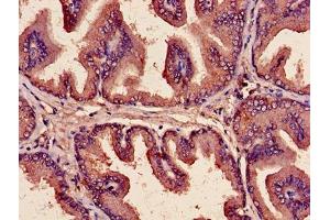Immunohistochemistry of paraffin-embedded human prostate cancer using ABIN7149190 at dilution of 1:100 (Cytochrome C1 antibody  (AA 85-325))