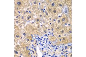 Immunohistochemistry of paraffin-embedded human liver injury using CARD11 antibody (ABIN5974295) at dilution of 1/100 (40x lens). (CARD11 antibody)