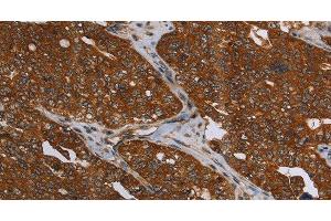 Immunohistochemistry of paraffin-embedded Human ovarian cancer using MCHR1 Polyclonal Antibody at dilution of 1:30 (MCHR1 antibody)