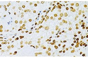 Immunohistochemistry of paraffin-embedded Human cancer using DKC1 Polyclonal Antibody at dilution of 1:200 (40x lens). (DKC1 antibody)