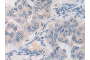 Detection of FDFT1 in Human Breast cancer Tissue using Polyclonal Antibody to Farnesyl Diphosphate Farnesyltransferase 1 (FDFT1)