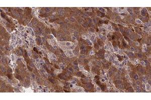 ABIN6277371 at 1/100 staining Human liver cancer tissue by IHC-P. (GRPR antibody  (Internal Region))