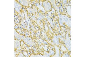 Immunohistochemistry of paraffin-embedded human liver cancer using TGFBI antibody (ABIN5971386) at dilution of 1/100 (40x lens).