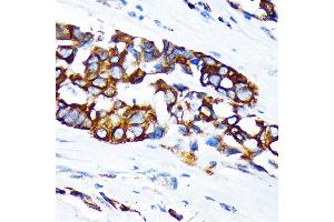 Immunohistochemistry of paraffin-embedded human lung cancer using KRT36 Rabbit pAb (ABIN6130229, ABIN6143029, ABIN6143030 and ABIN6217868) at dilution of 1:100 (40x lens). (Keratin 36 antibody  (AA 388-467))
