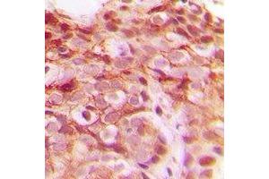 Immunohistochemical analysis of DNAJB4 staining in human breast cancer formalin fixed paraffin embedded tissue section. (DNAJB4 antibody)