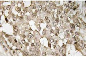 Immunohistochemistry (IHC) analyzes of p-NFkappaB-p65 antibody in paraffin-embedded human breast carcinoma tissue. (NF-kB p65 antibody  (pSer529))