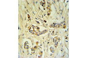 FIBB Antibody (C-term) (ABIN390414 and ABIN2840803) IHC analysis in formalin fixed and paraffin embedded human breast carcinoma followed by peroxidase conjugation of the secondary antibody and DAB staining. (Fibrinogen beta Chain antibody  (C-Term))