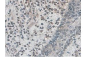 IHC-P analysis of Human Skin Cancer Tissue, with DAB staining. (PALLD antibody  (AA 1137-1383))