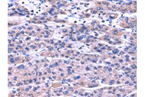 The image on the left is immunohistochemistry of paraffin-embedded Human liver cancer tissue using ABIN7131486(TRIM49 Antibody) at dilution 1/40, on the right is treated with fusion protein. (TRIM49 antibody)