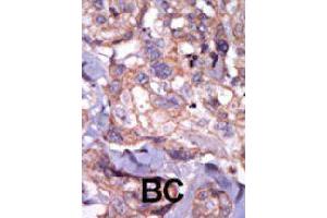 Formalin-fixed and paraffin-embedded human cancer tissue reacted with TXK polyclonal antibody  , which was peroxidase-conjugated to the secondary antibody, followed by AEC staining. (TXK antibody  (N-Term))